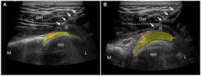 A retrospective study of ultrasound-guided intervention for frozen shoulder in the frozen stage